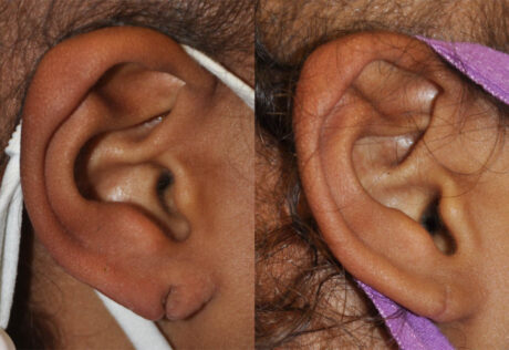 Otoplasty case #4667