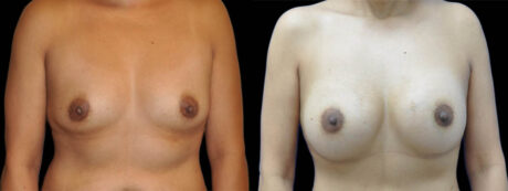 Breast Augmentation case #4657