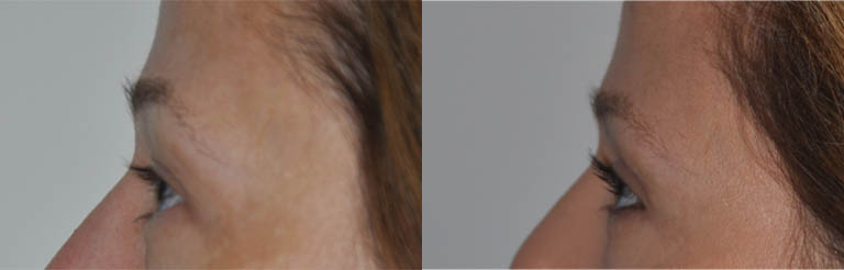 Blepharoplasty case #5324