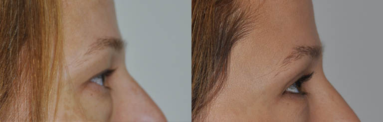 Blepharoplasty case #5324