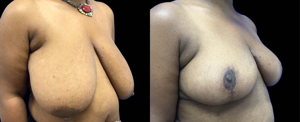 Breast Reduction case #5428