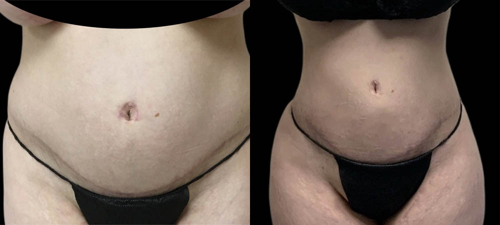 Liposuction case #5875