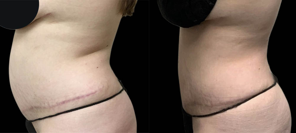 Liposuction case #5875