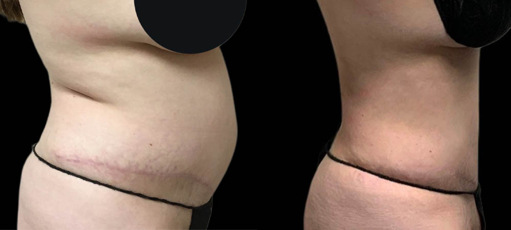 Liposuction case #5875