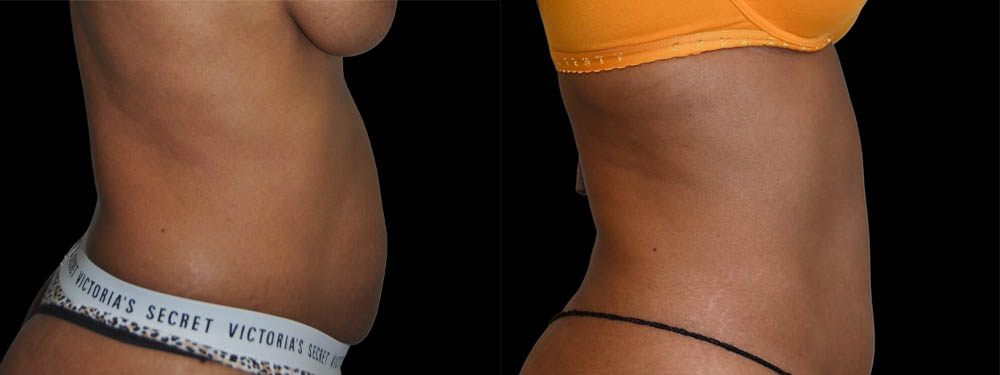 Tummy Tuck case #5848