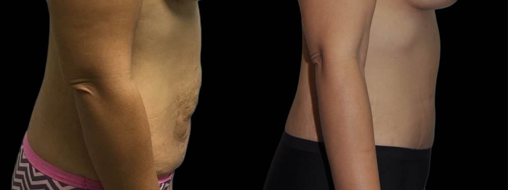 Tummy Tuck case #5859