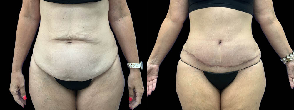 Tummy Tuck case #5852