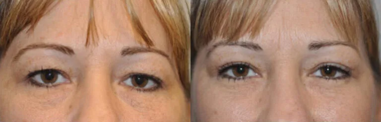 Before & After Eyelid Surgery Results