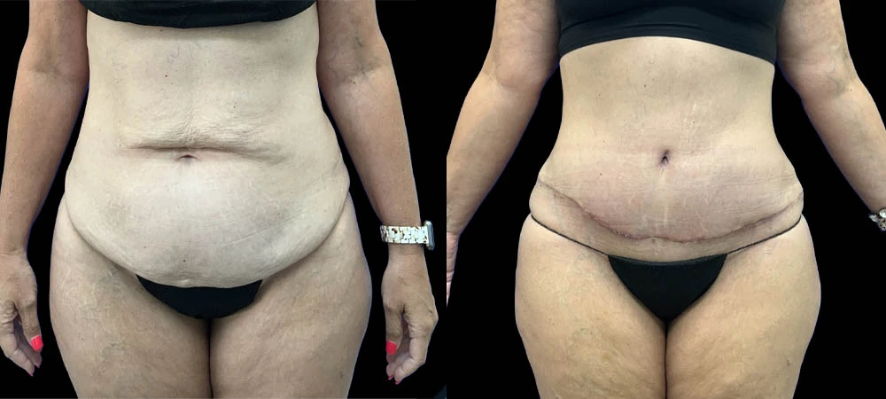 0005_ABDOMEN-ANTERIOR-VIEW-BEFORE.JPEG-1