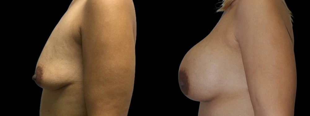 0006_3BREASTS-LEFT-LATERAL-VIEW-AFTER.JPG