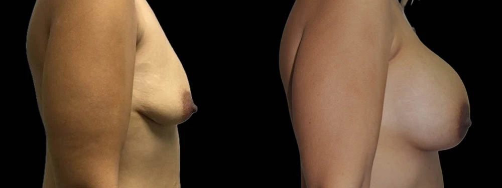 0007_3BREASTS-RIGHT-LATERAL-VIEW-AFTER.JPG