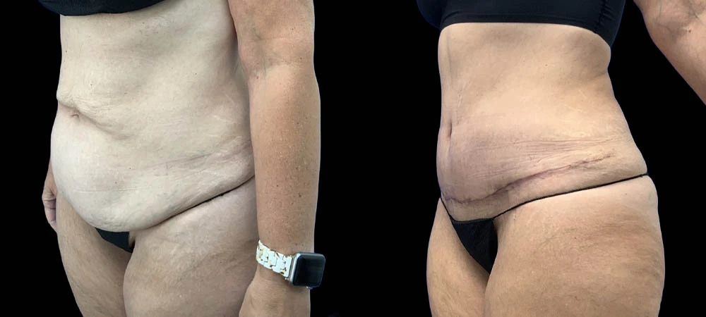 0007_ABDOMEN-LEFT-OBLIQUE-VIEW-BEFORE.JPEG
