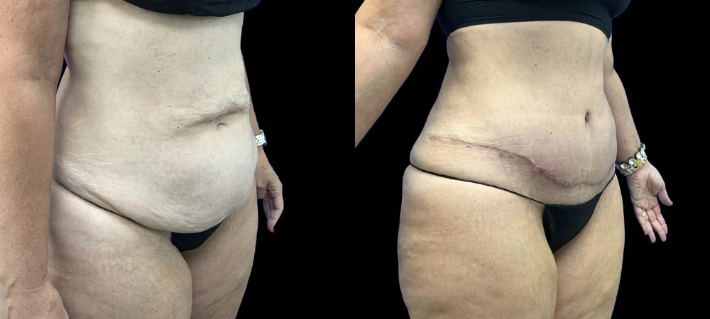 0009_ABDOMEN-RIGHT-OBLIQUE-VIEW-BEFORE.JPEG