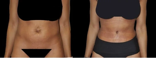 Before & After: Tummy Tuck