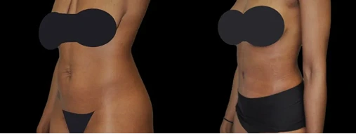 Before & After: Tummy Tuck