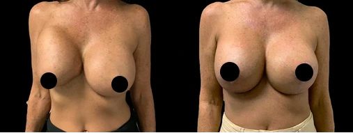 Before & After Gallery: Breast Lift With Implants