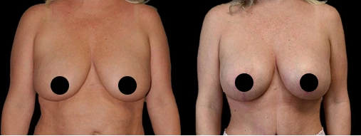 Before & After Gallery: Breast Lift With Implants