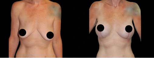 Before & After Gallery: Breast Lift With Implants