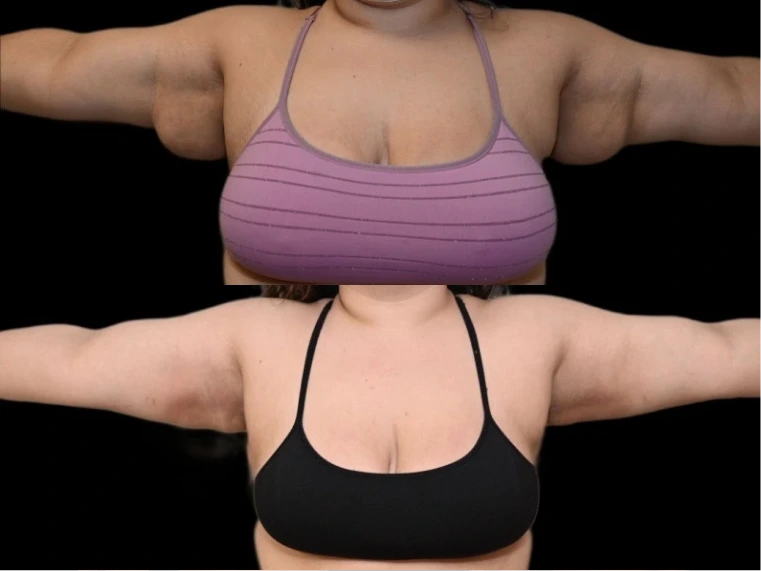 Arm Lift Results