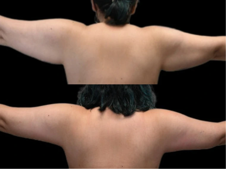 Arm Lift Results